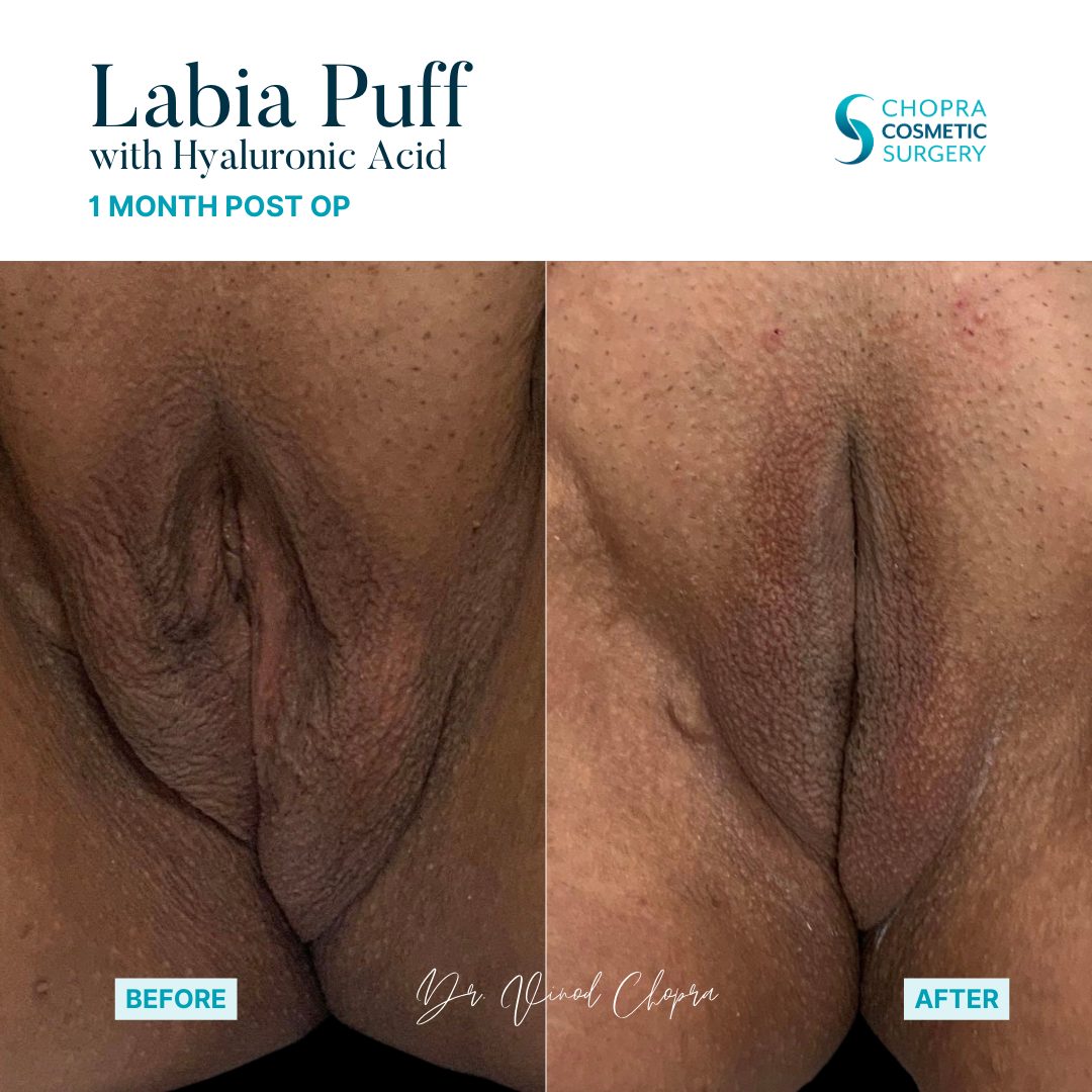 Labia Puff Filler Real Patient Results by Dr. Vinod Chopra in Washington, D.C. and Fairfax, VA