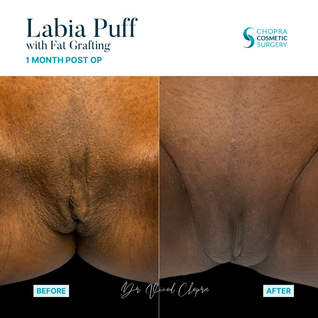 Labia Puff Filler Real Patient Results by Dr. Vinod Chopra in Washington, D.C. and Fairfax, VA