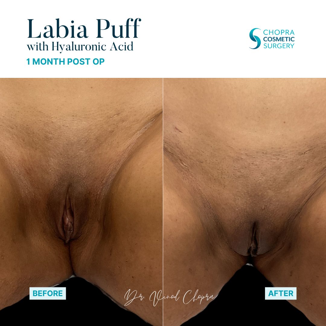 Labia Puff Filler Real Patient Results by Dr. Vinod Chopra in Washington, D.C. and Fairfax, VA