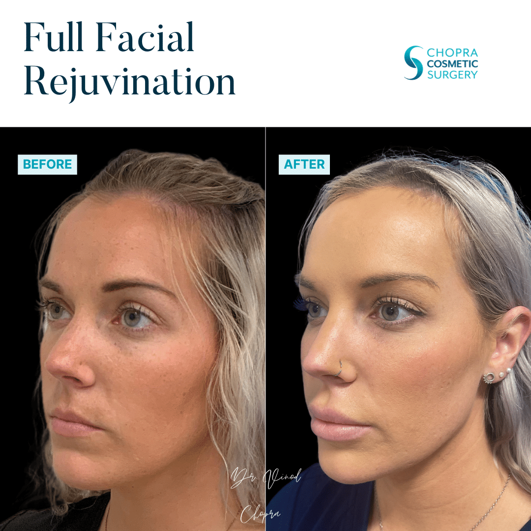 Full Facial Rejuvenation Real Patient Results by Dr. Vinod Chopra in Washington, D.C. and Fairfax, VA