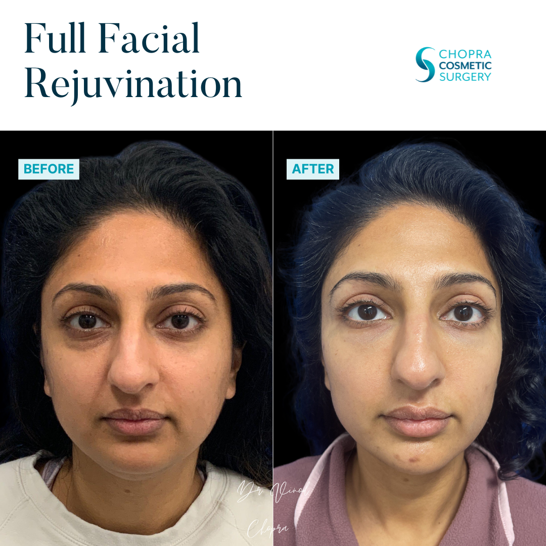 Full Facial Rejuvenation Real Patient Results by Dr. Vinod Chopra in Washington, D.C. and Fairfax, VA