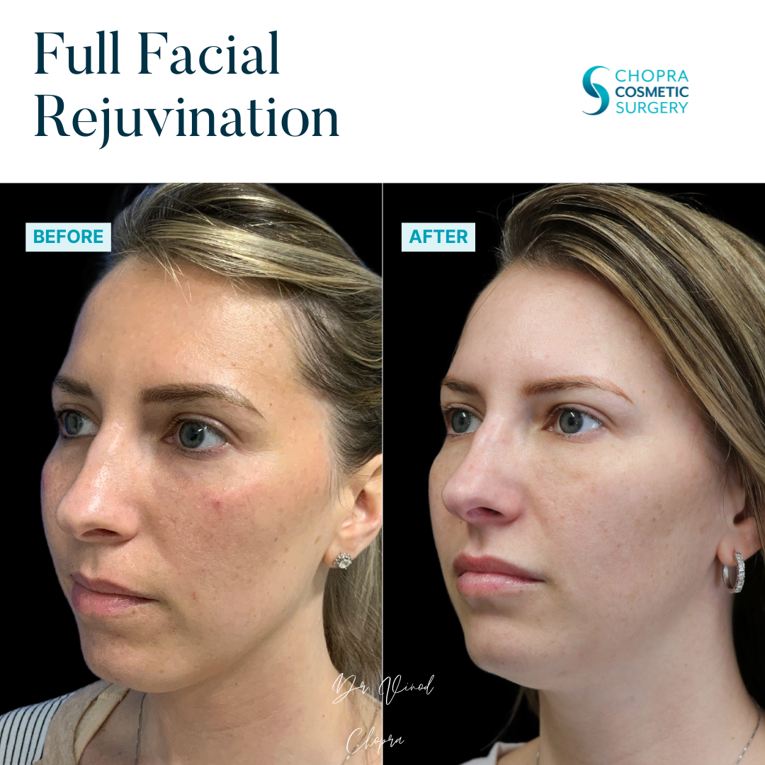 Full Facial Rejuvenation Real Patient Results by Dr. Vinod Chopra in Washington, D.C. and Fairfax, VA