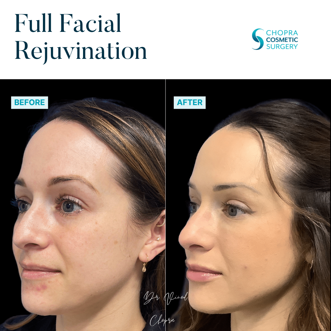 Full Facial Rejuvenation Real Patient Results by Dr. Vinod Chopra in Washington, D.C. and Fairfax, VA