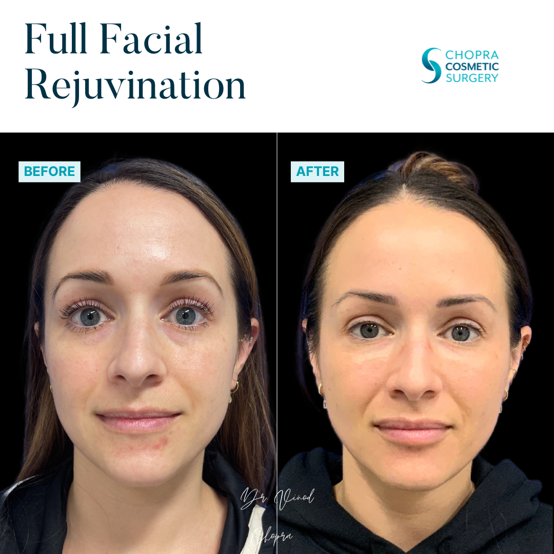 Full Facial Rejuvenation Real Patient Results by Dr. Vinod Chopra in Washington, D.C. and Fairfax, VA