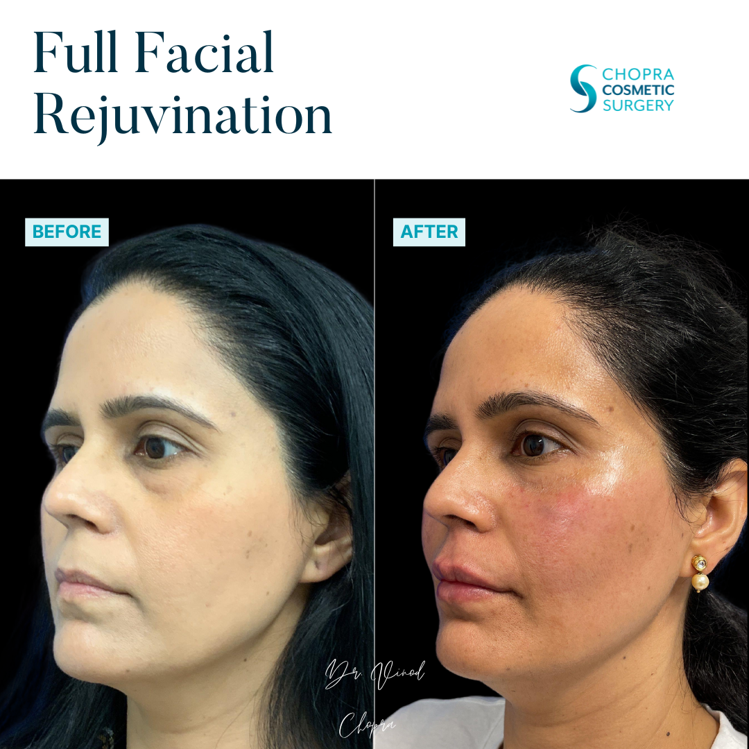Full Facial Rejuvenation Real Patient Results by Dr. Vinod Chopra in Washington, D.C. and Fairfax, VA