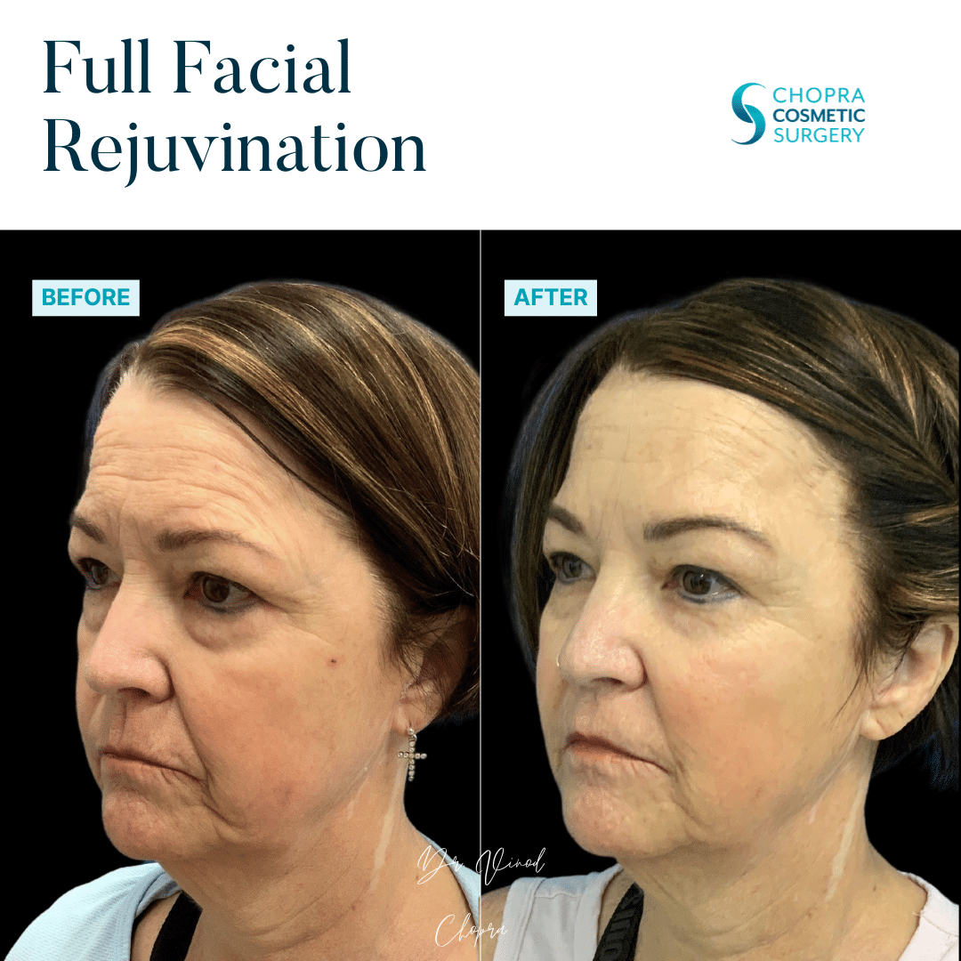 Full Facial Rejuvenation Real Patient Results by Dr. Vinod Chopra in Washington, D.C. and Fairfax, VA