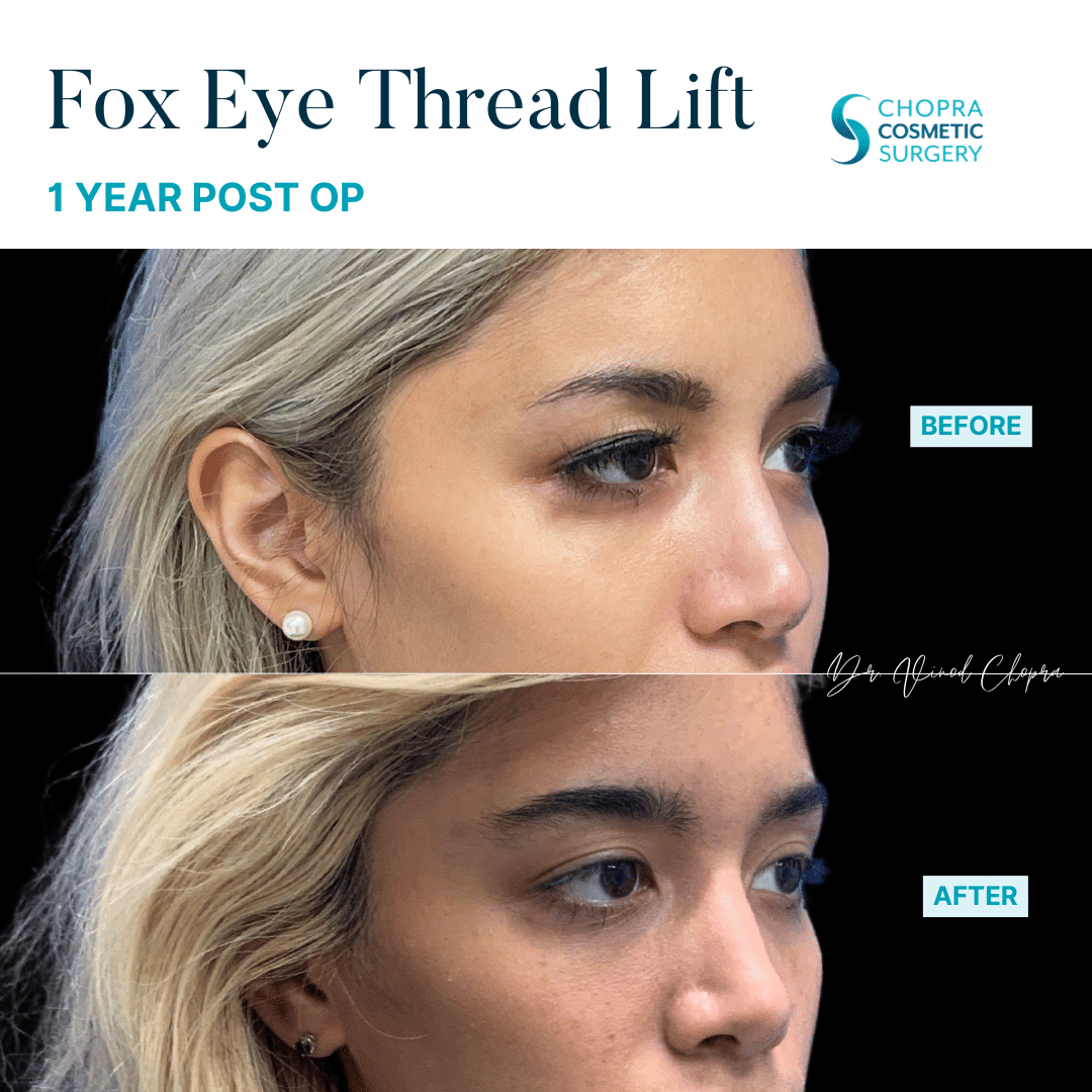 Threads Real Patient Results by Dr. Vinod Chopra in Washington, D.C. and Fairfax, VA