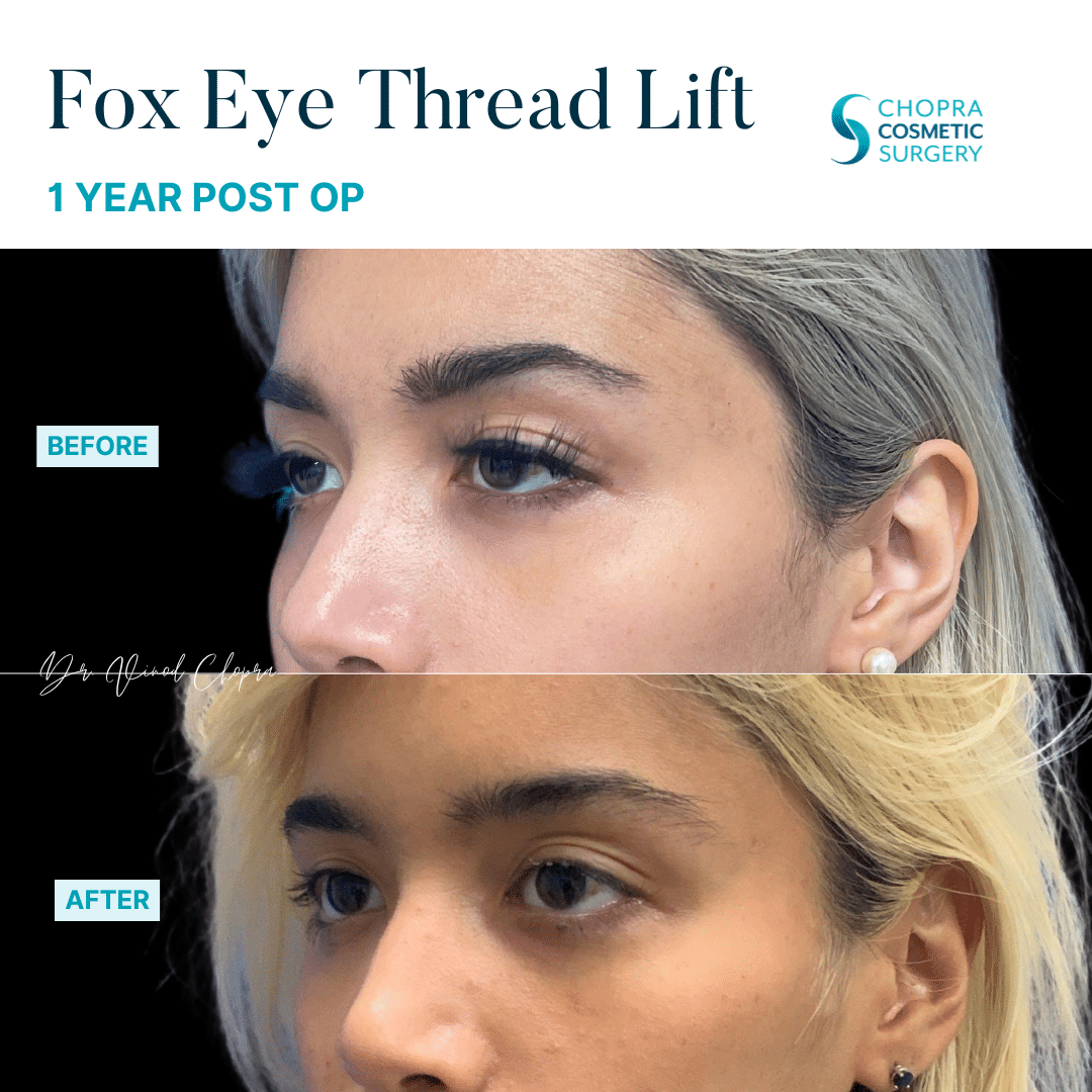 Threads Real Patient Results by Dr. Vinod Chopra in Washington, D.C. and Fairfax, VA