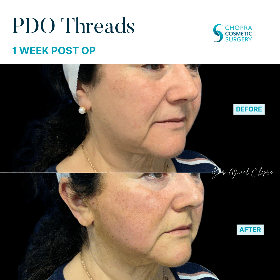 Threads Real Patient Results by Dr. Vinod Chopra in Washington, D.C. and Fairfax, VA