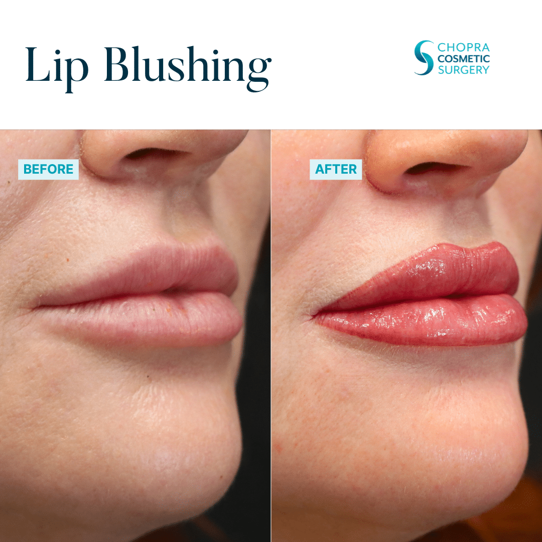 Permanent Makeup Real Patient Results by Dr. Vinod Chopra in Washington, D.C. and Fairfax, VA