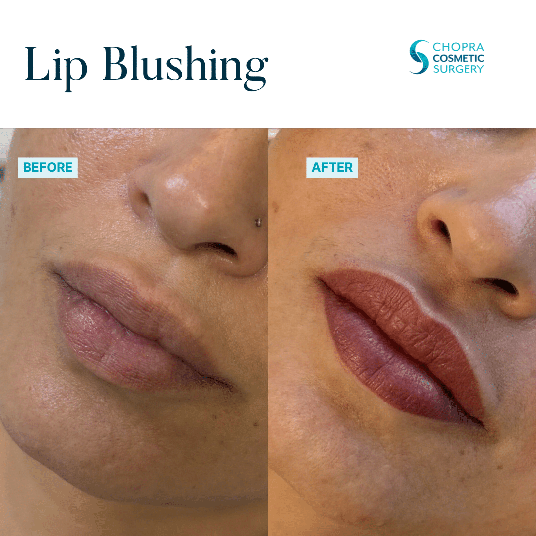 Permanent Makeup Real Patient Results by Dr. Vinod Chopra in Washington, D.C. and Fairfax, VA