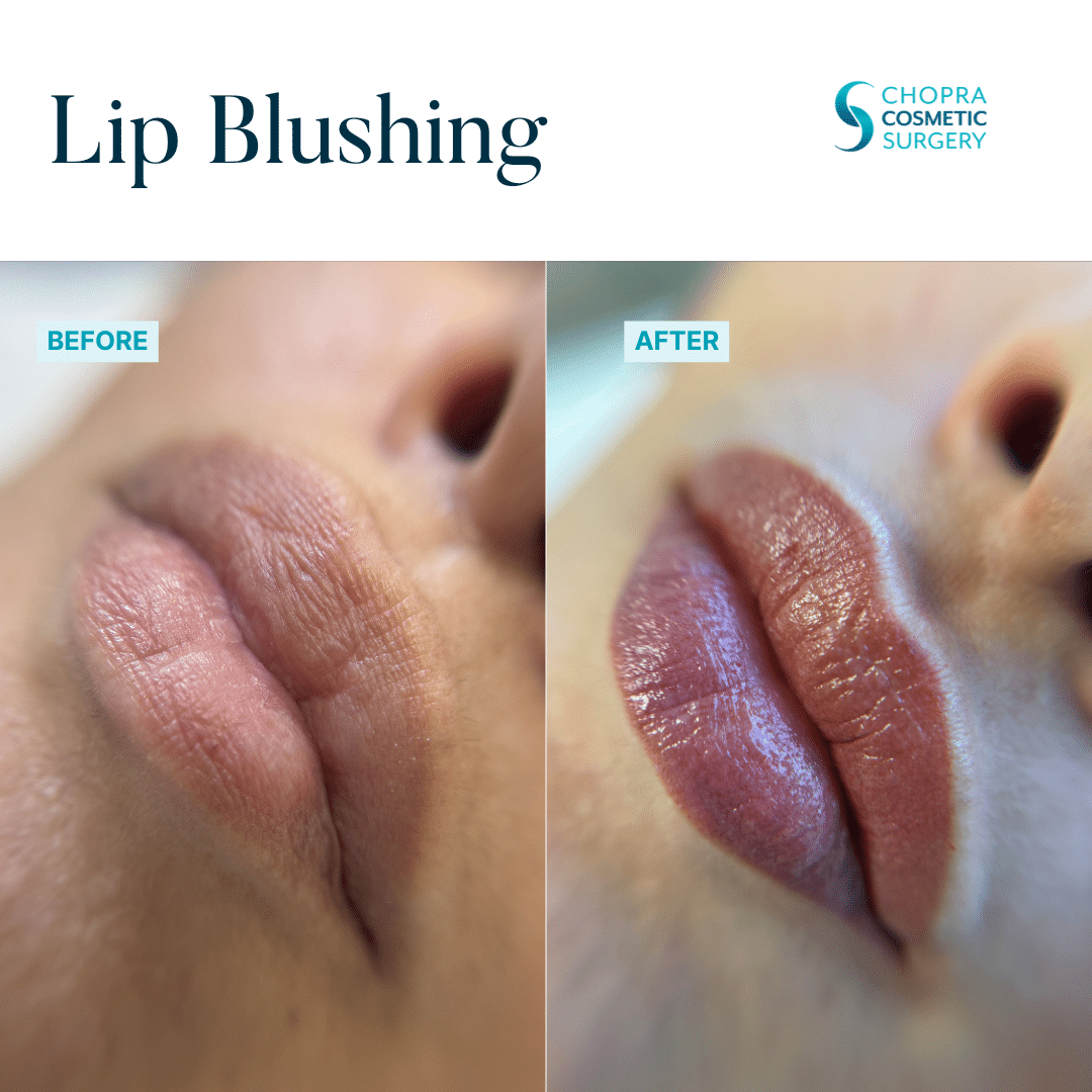 Permanent Makeup Real Patient Results by Dr. Vinod Chopra in Washington, D.C. and Fairfax, VA