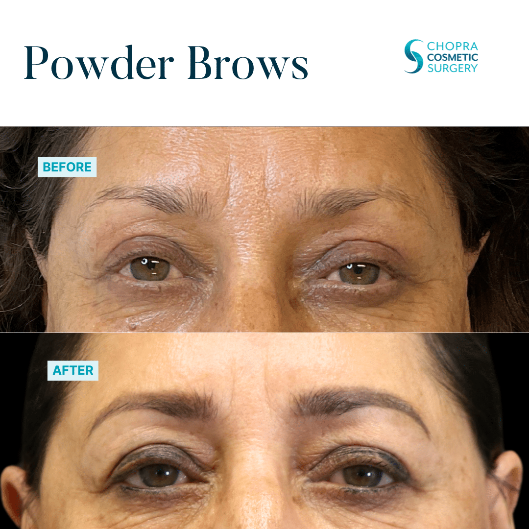 Permanent Makeup Real Patient Results by Dr. Vinod Chopra in Washington, D.C. and Fairfax, VA