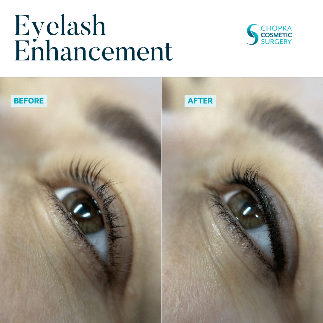 Permanent Makeup Real Patient Results by Dr. Vinod Chopra in Washington, D.C. and Fairfax, VA