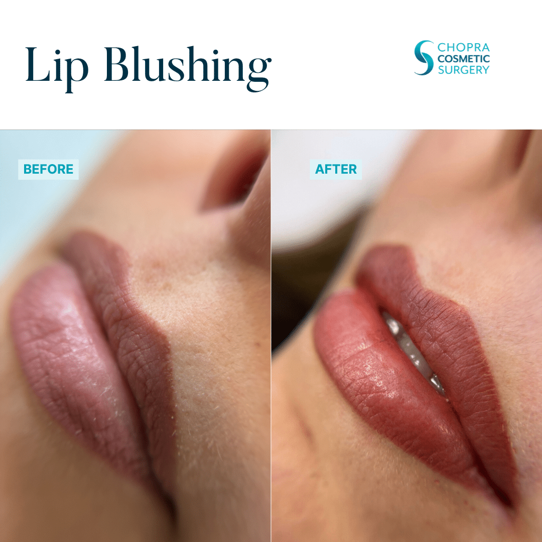 Permanent Makeup Real Patient Results by Dr. Vinod Chopra in Washington, D.C. and Fairfax, VA