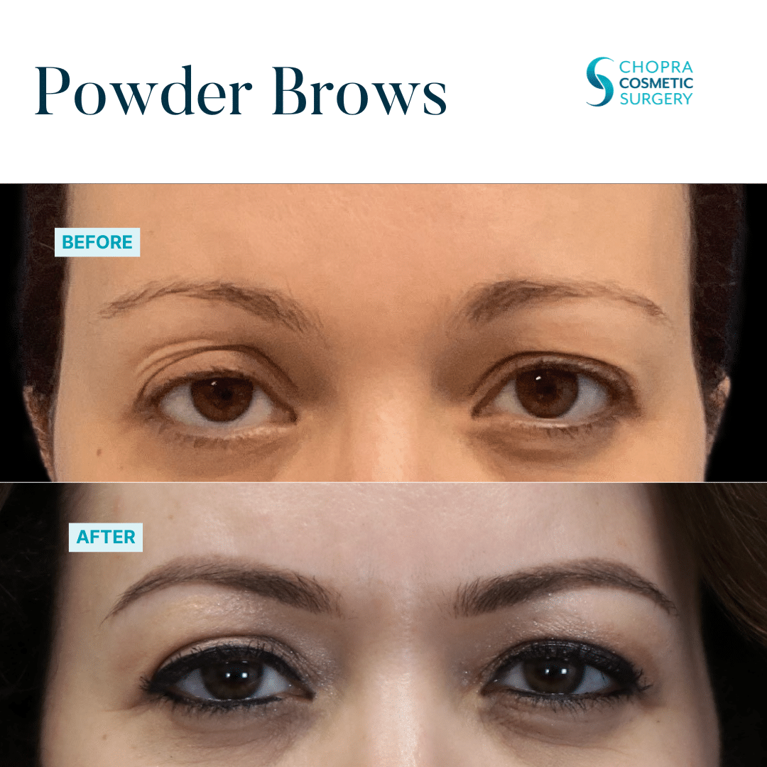 Permanent Makeup Real Patient Results by Dr. Vinod Chopra in Washington, D.C. and Fairfax, VA
