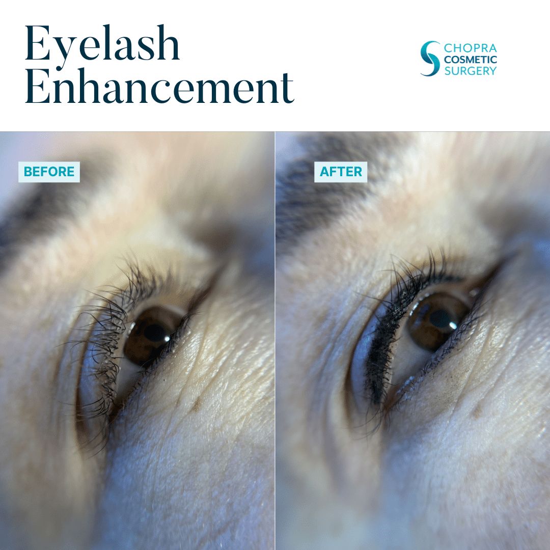 Permanent Makeup Real Patient Results by Dr. Vinod Chopra in Washington, D.C. and Fairfax, VA