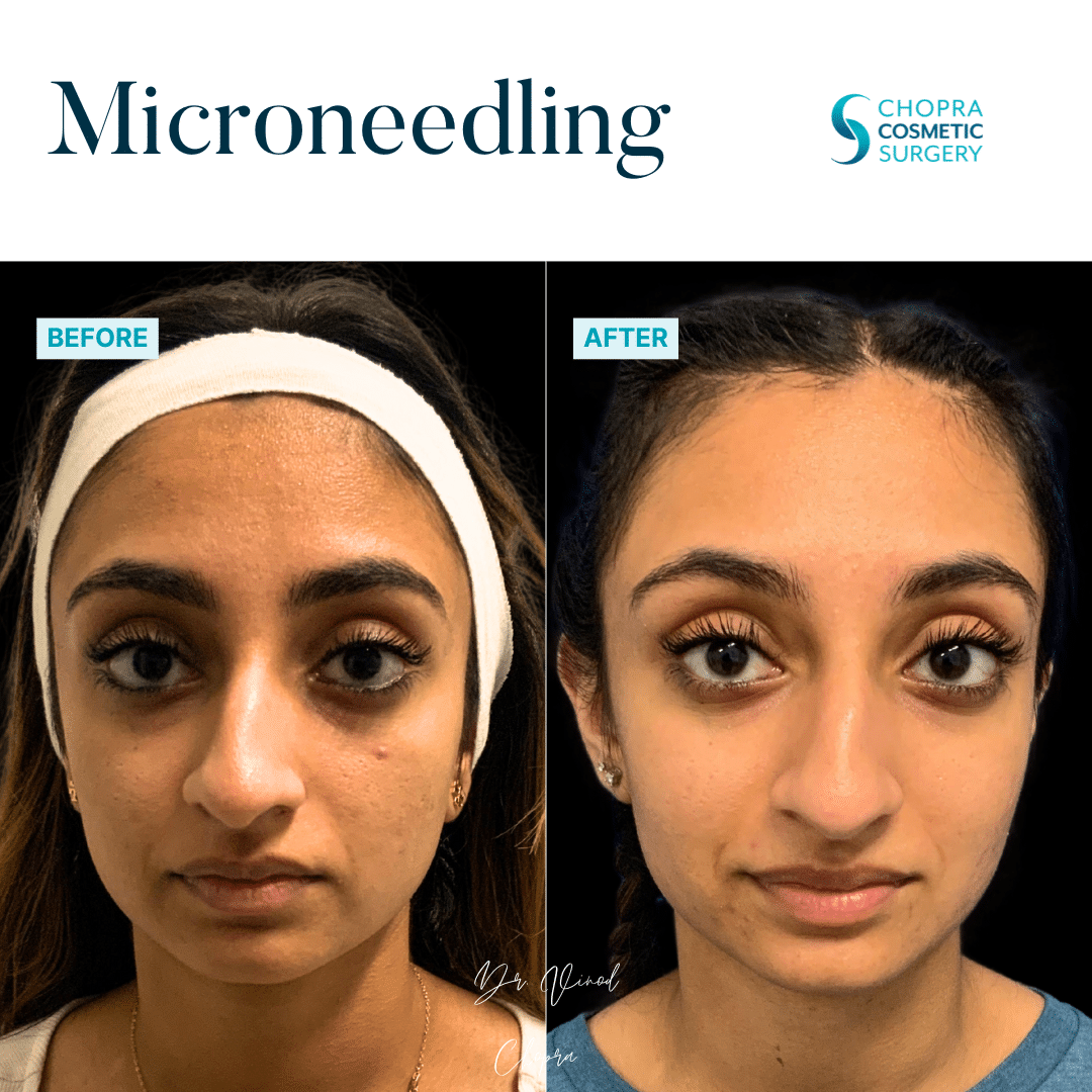 Microneedling Real Patient Results by Dr. Vinod Chopra in Washington, D.C. and Fairfax, VA