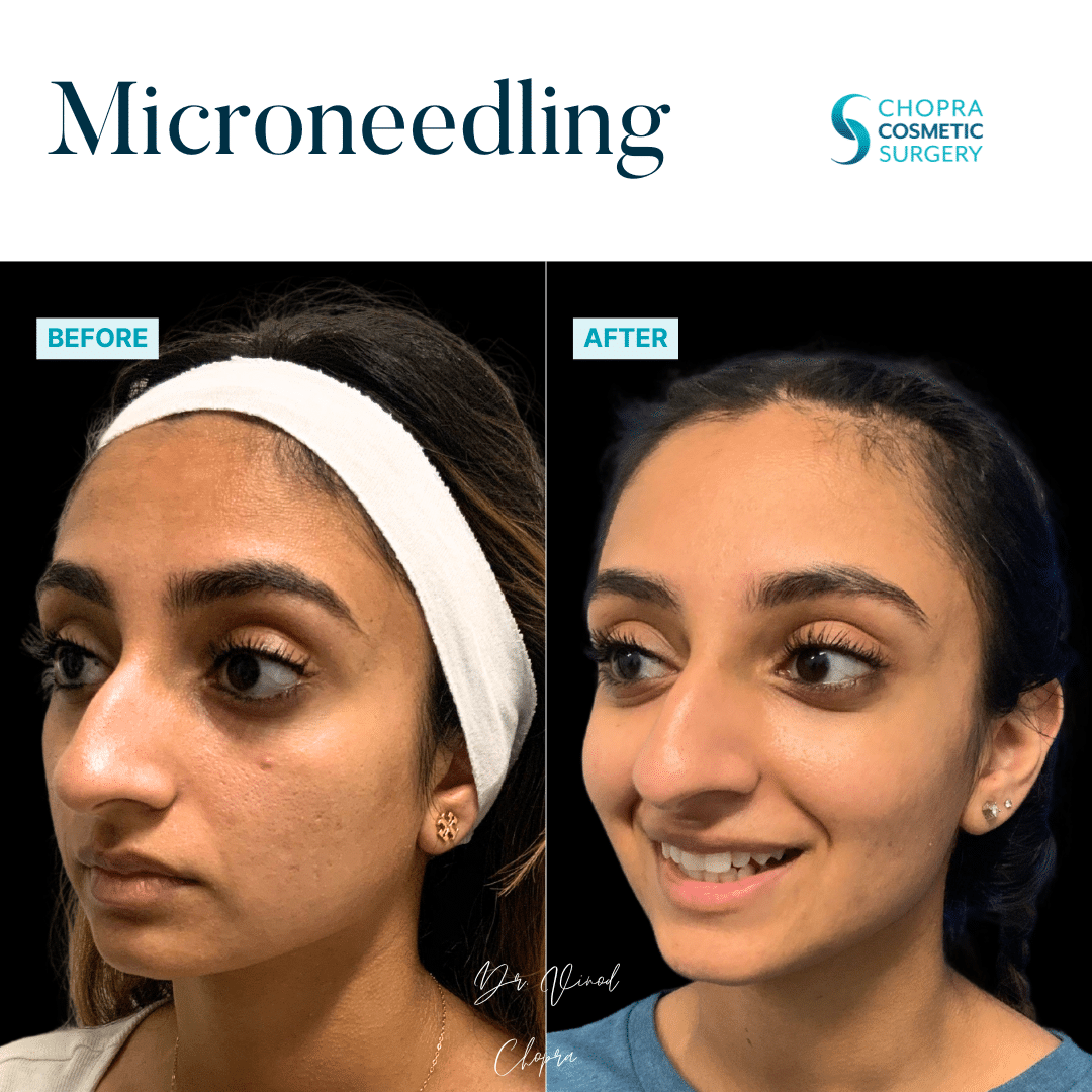 Microneedling Real Patient Results by Dr. Vinod Chopra in Washington, D.C. and Fairfax, VA