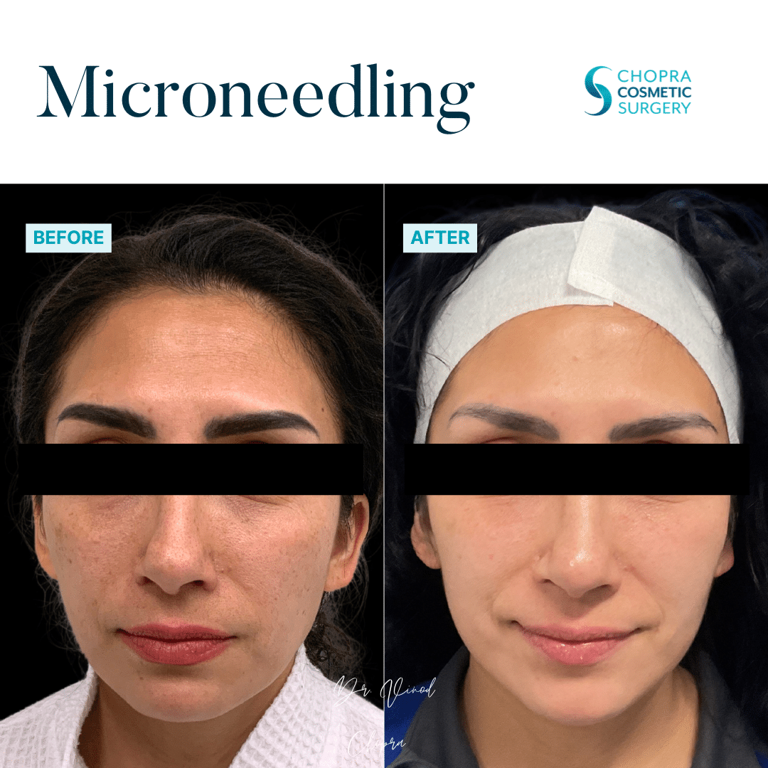 Microneedling Real Patient Results by Dr. Vinod Chopra in Washington, D.C. and Fairfax, VA
