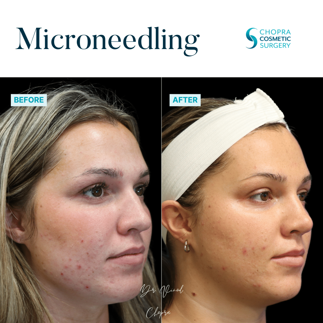 Microneedling Real Patient Results by Dr. Vinod Chopra in Washington, D.C. and Fairfax, VA