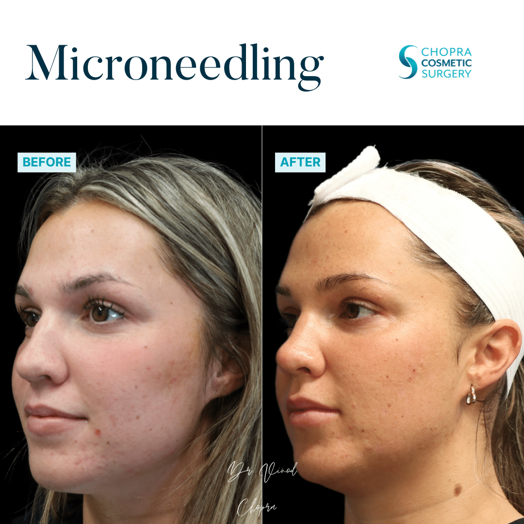 Microneedling Real Patient Results by Dr. Vinod Chopra in Washington, D.C. and Fairfax, VA