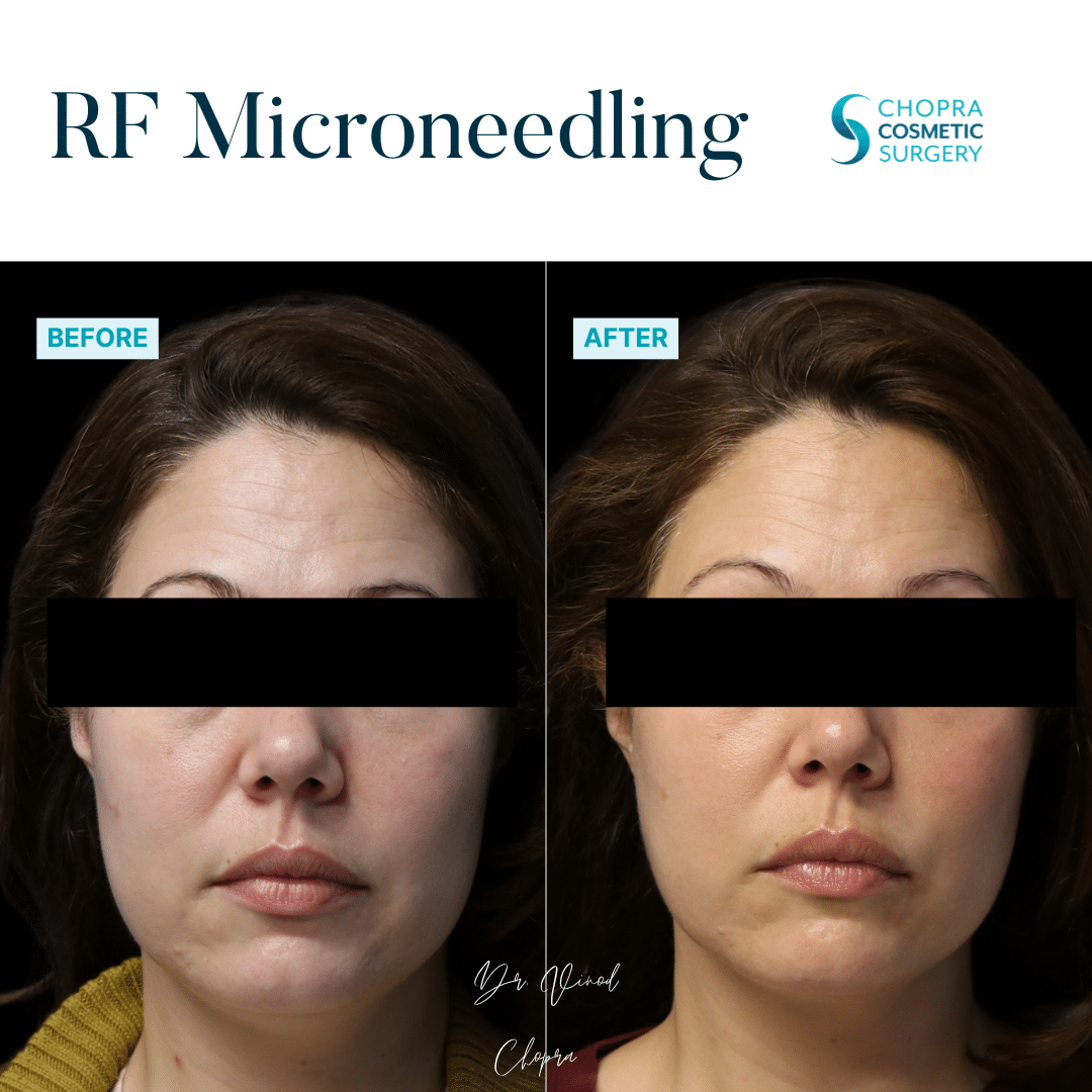 Microneedling Real Patient Results by Dr. Vinod Chopra in Washington, D.C. and Fairfax, VA