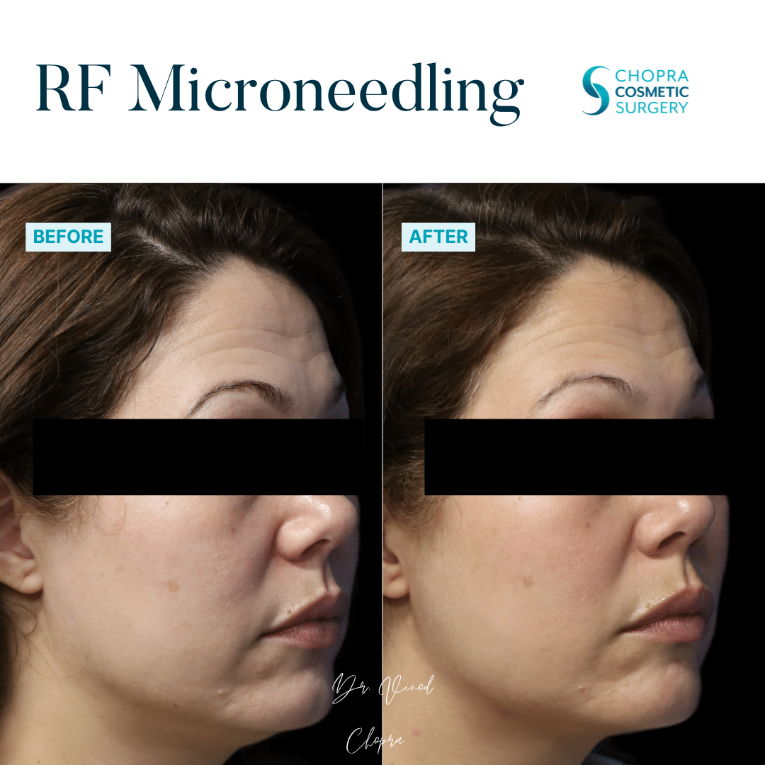 Microneedling Real Patient Results by Dr. Vinod Chopra in Washington, D.C. and Fairfax, VA