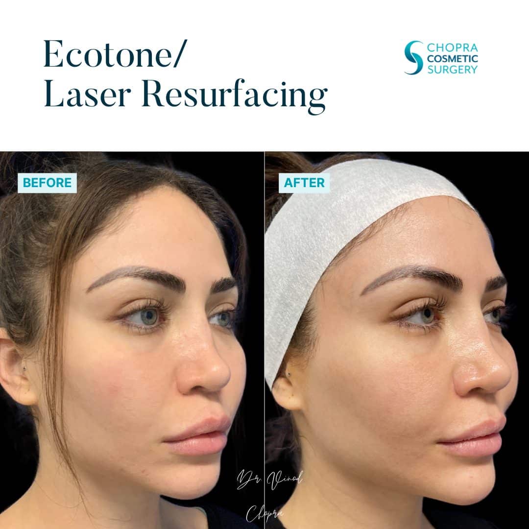 Eco Tone Real Patient Results by Dr. Vinod Chopra in Washington, D.C. and Fairfax, VA