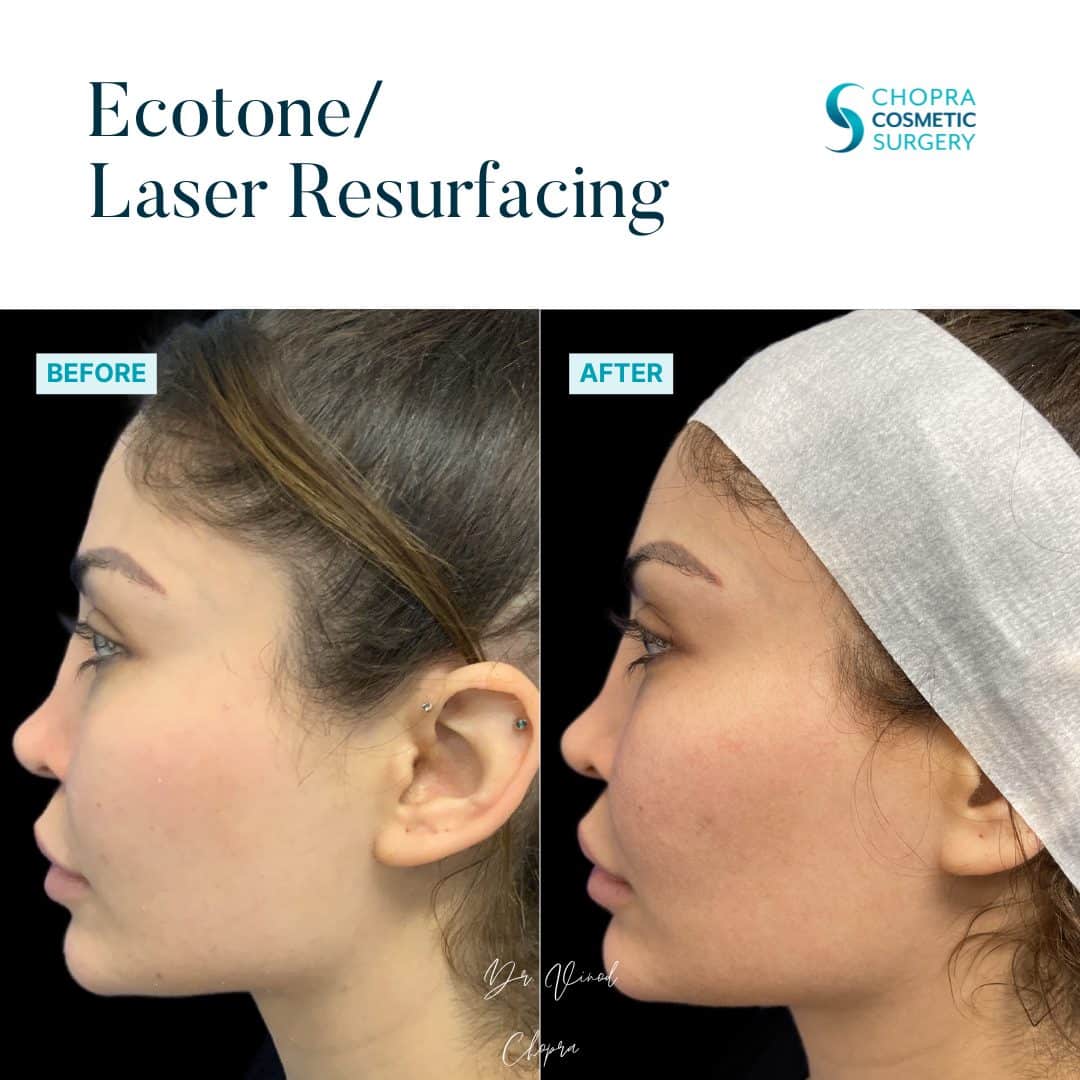 Eco Tone Real Patient Results by Dr. Vinod Chopra in Washington, D.C. and Fairfax, VA