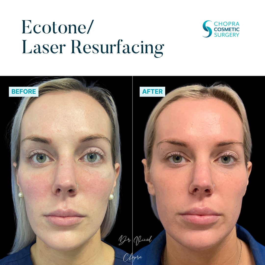Eco Tone Real Patient Results by Dr. Vinod Chopra in Washington, D.C. and Fairfax, VA