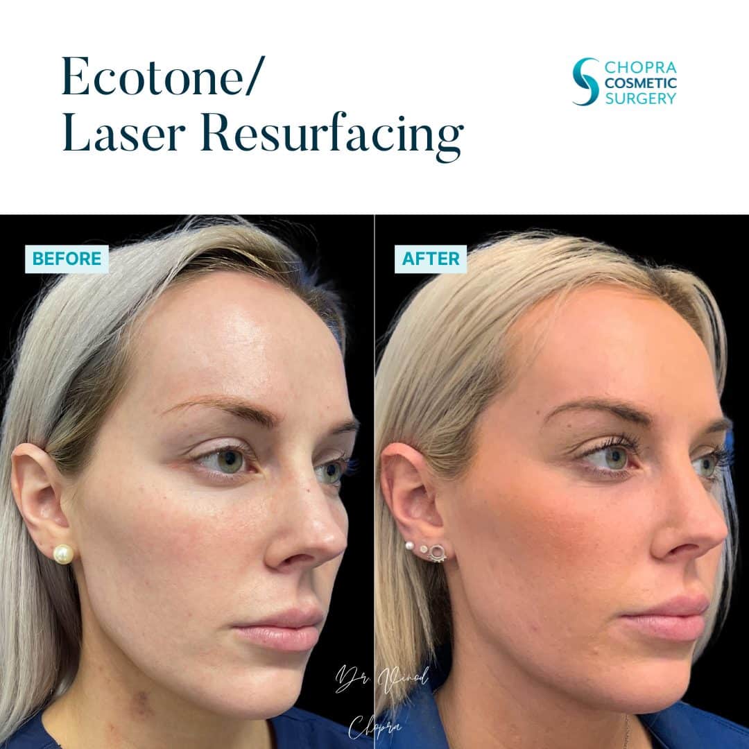 Eco Tone Real Patient Results by Dr. Vinod Chopra in Washington, D.C. and Fairfax, VA