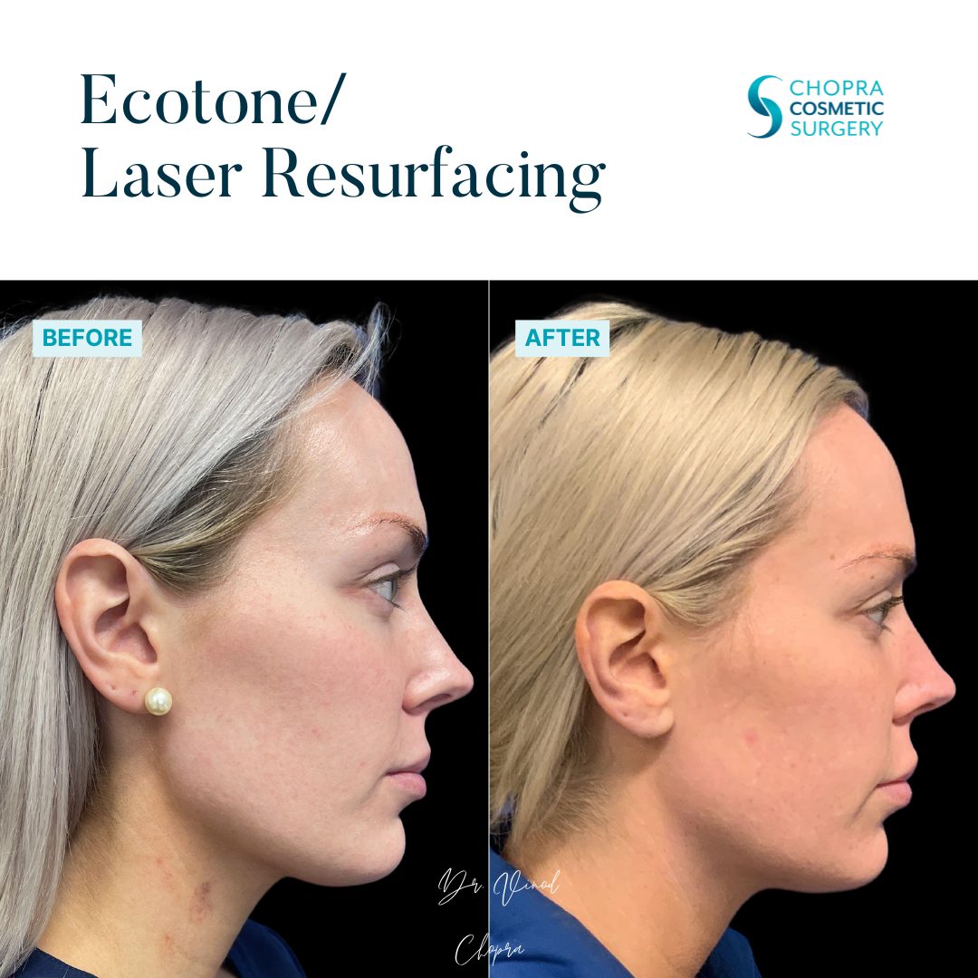 Eco Tone Real Patient Results by Dr. Vinod Chopra in Washington, D.C. and Fairfax, VA