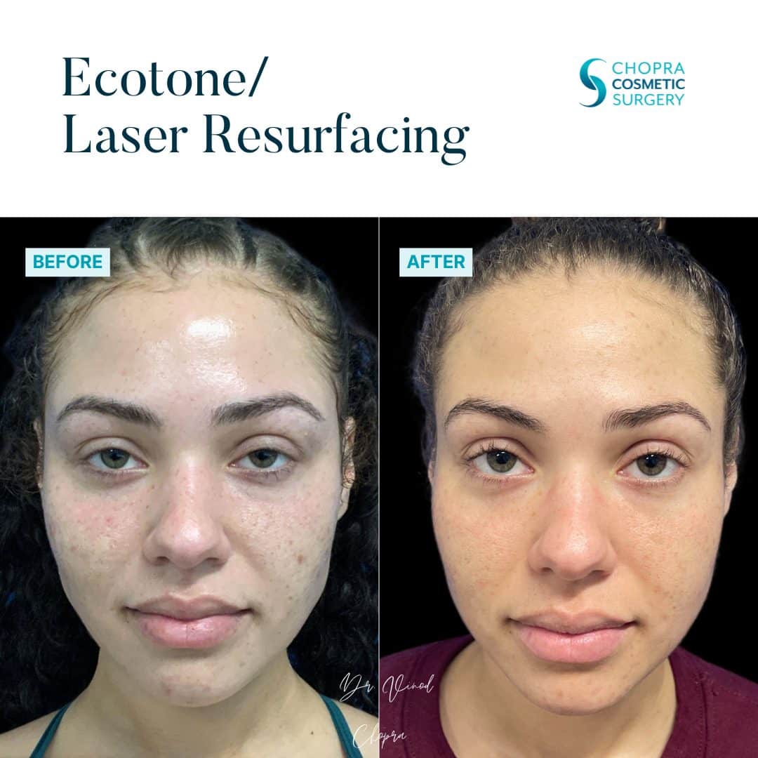 Eco Tone Real Patient Results by Dr. Vinod Chopra in Washington, D.C. and Fairfax, VA
