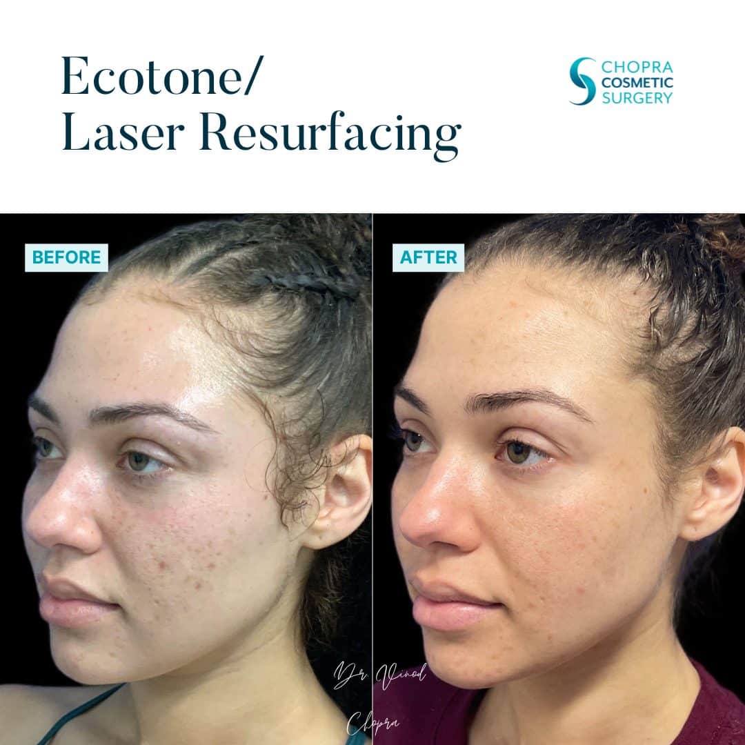 Eco Tone Real Patient Results by Dr. Vinod Chopra in Washington, D.C. and Fairfax, VA