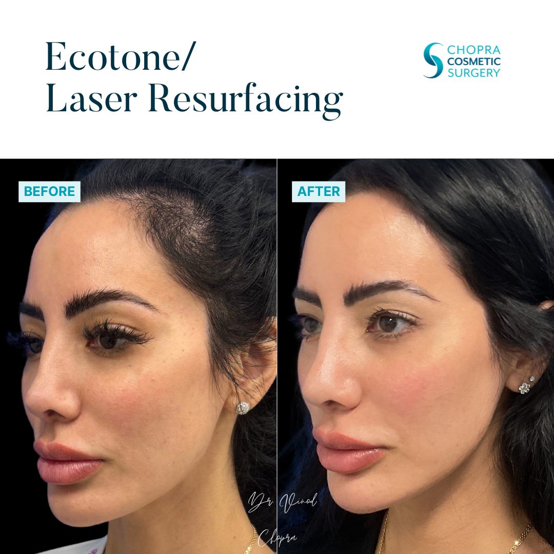 Eco Tone Real Patient Results by Dr. Vinod Chopra in Washington, D.C. and Fairfax, VA