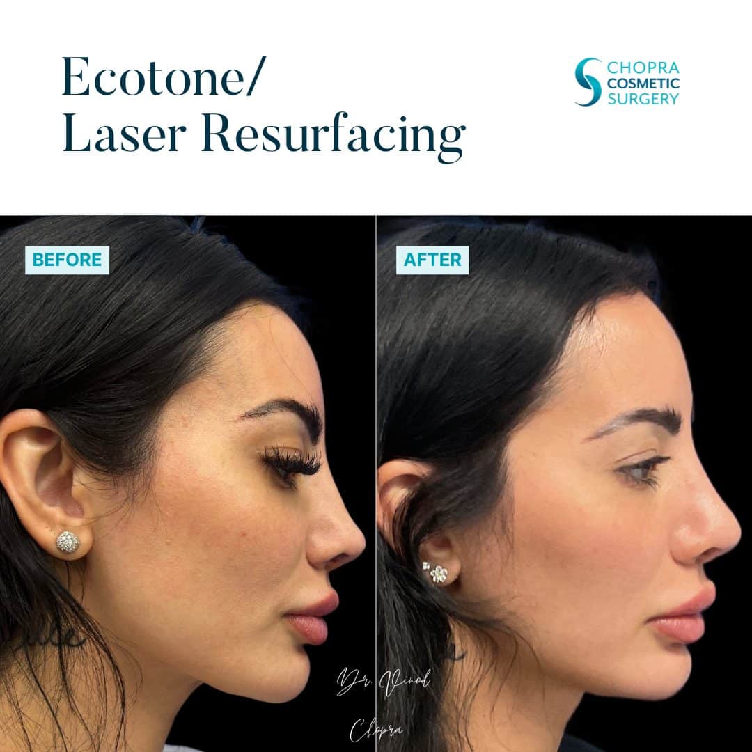 Eco Tone Real Patient Results by Dr. Vinod Chopra in Washington, D.C. and Fairfax, VA