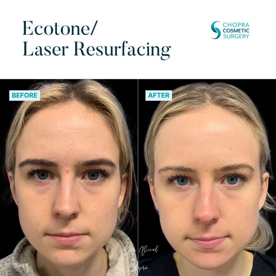 Eco Tone Real Patient Results by Dr. Vinod Chopra in Washington, D.C. and Fairfax, VA