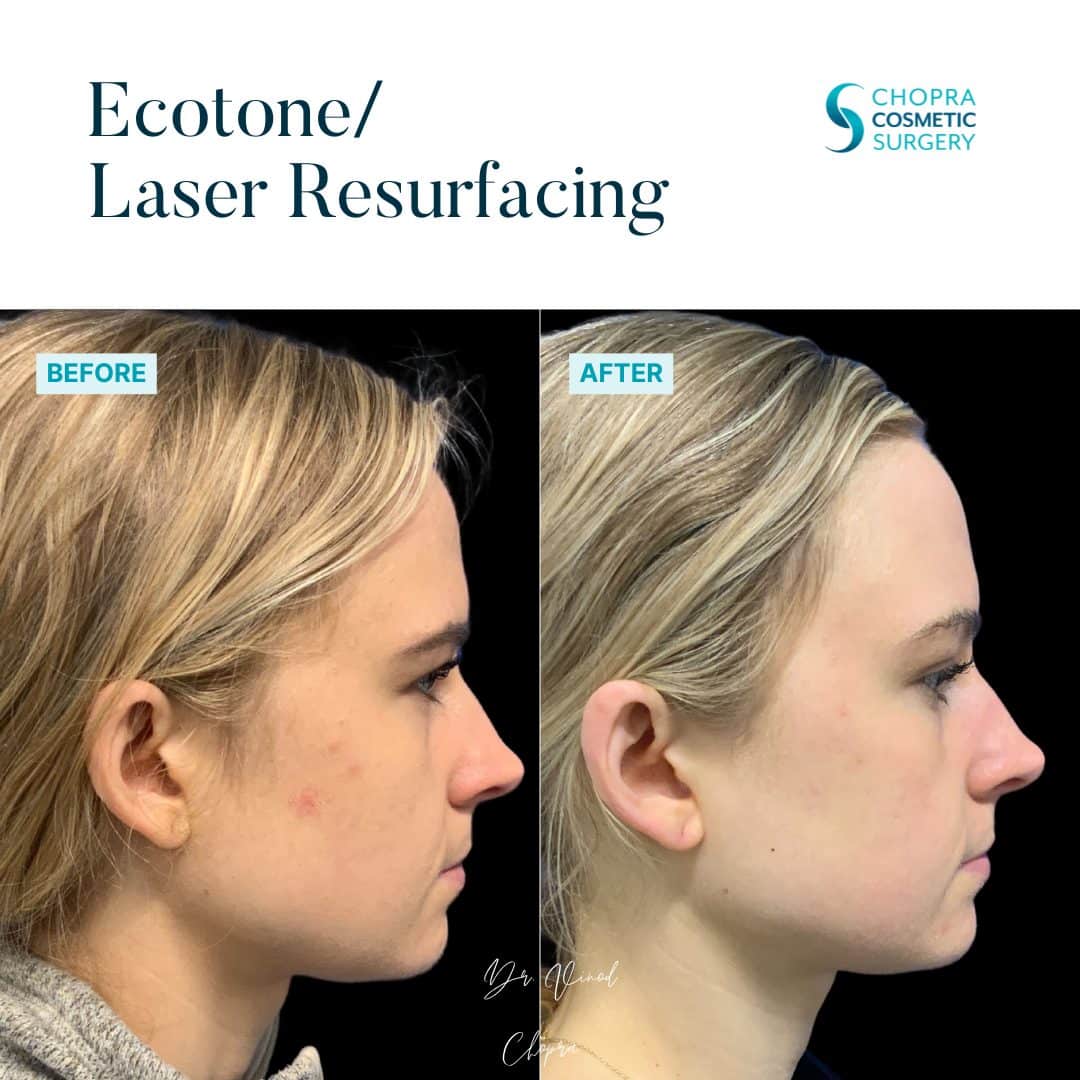 Eco Tone Real Patient Results by Dr. Vinod Chopra in Washington, D.C. and Fairfax, VA