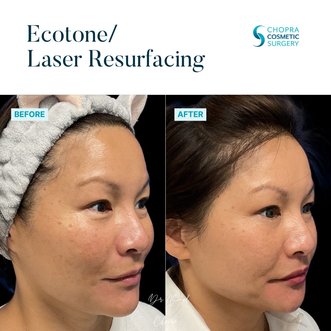 Eco Tone Real Patient Results by Dr. Vinod Chopra in Washington, D.C. and Fairfax, VA