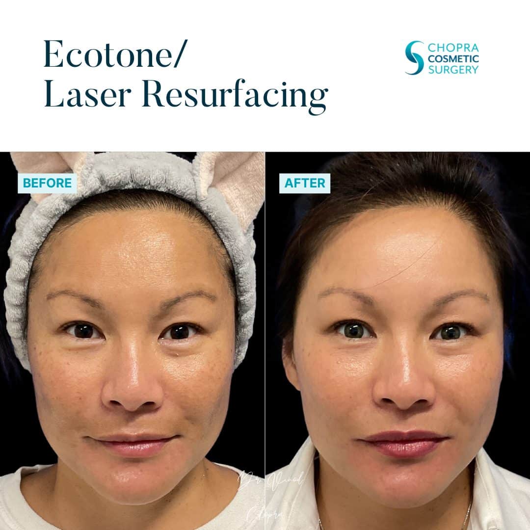 Eco Tone Real Patient Results by Dr. Vinod Chopra in Washington, D.C. and Fairfax, VA
