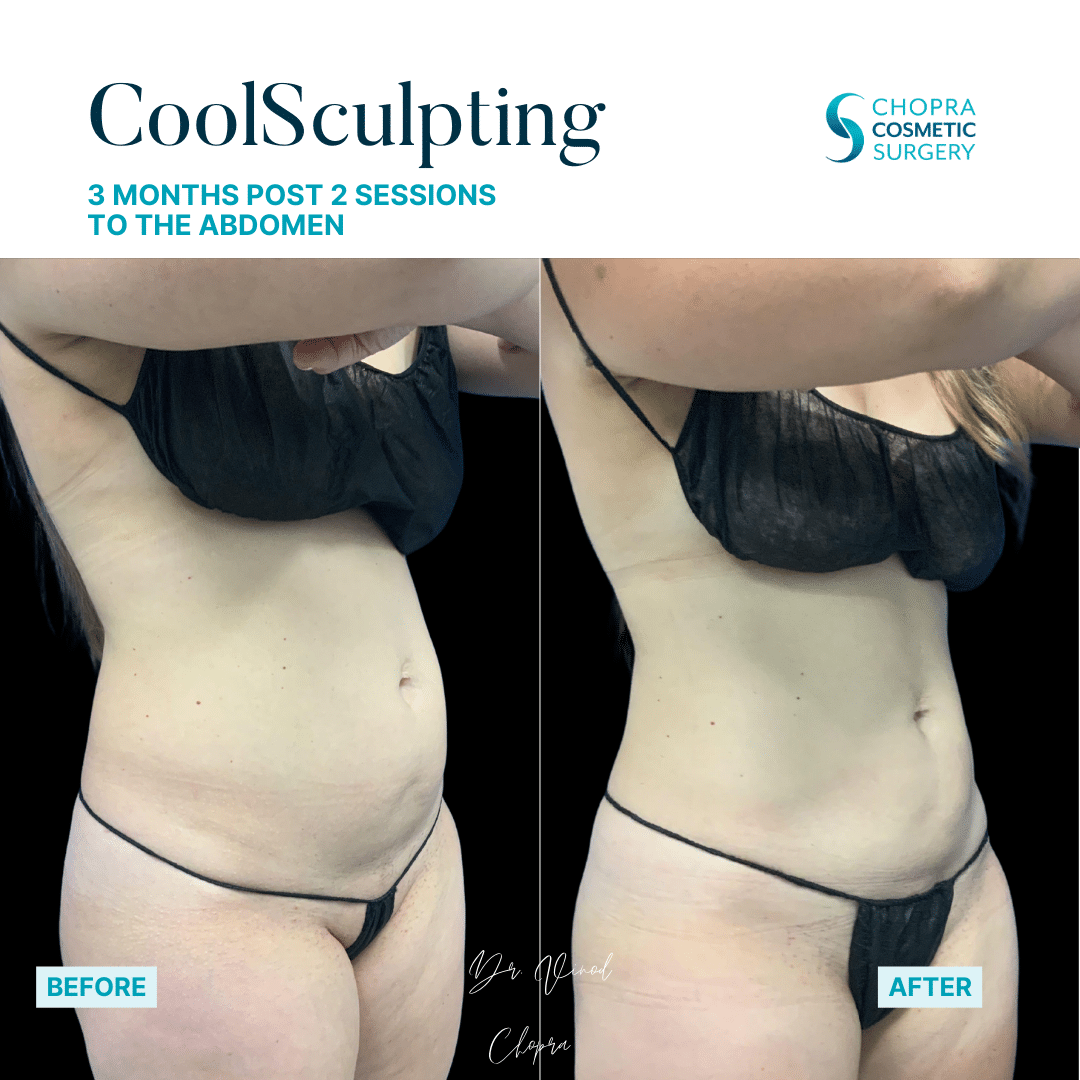 CoolSculpting Real Patient Results by Dr. Vinod Chopra in Washington, D.C. and Fairfax, VA