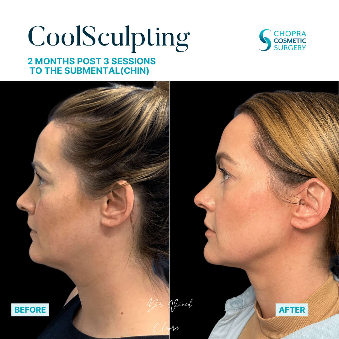 CoolSculpting Real Patient Results by Dr. Vinod Chopra in Washington, D.C. and Fairfax, VA