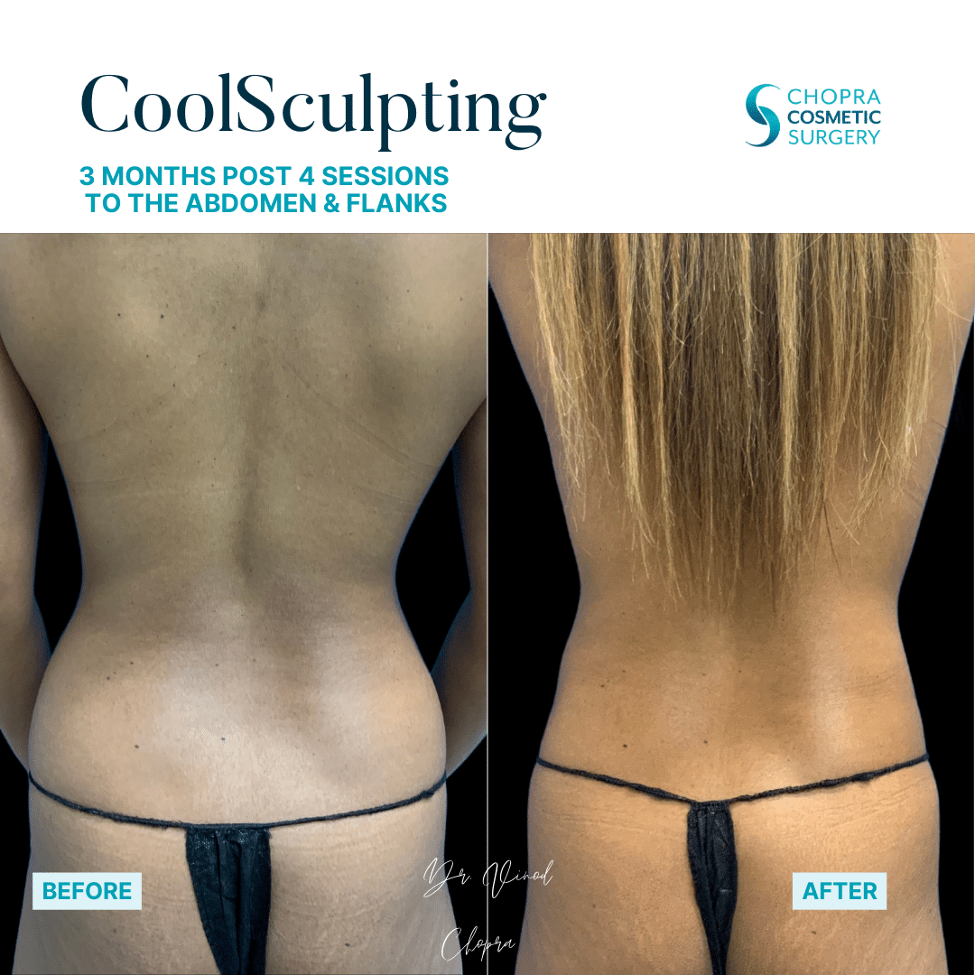 CoolSculpting Real Patient Results by Dr. Vinod Chopra in Washington, D.C. and Fairfax, VA