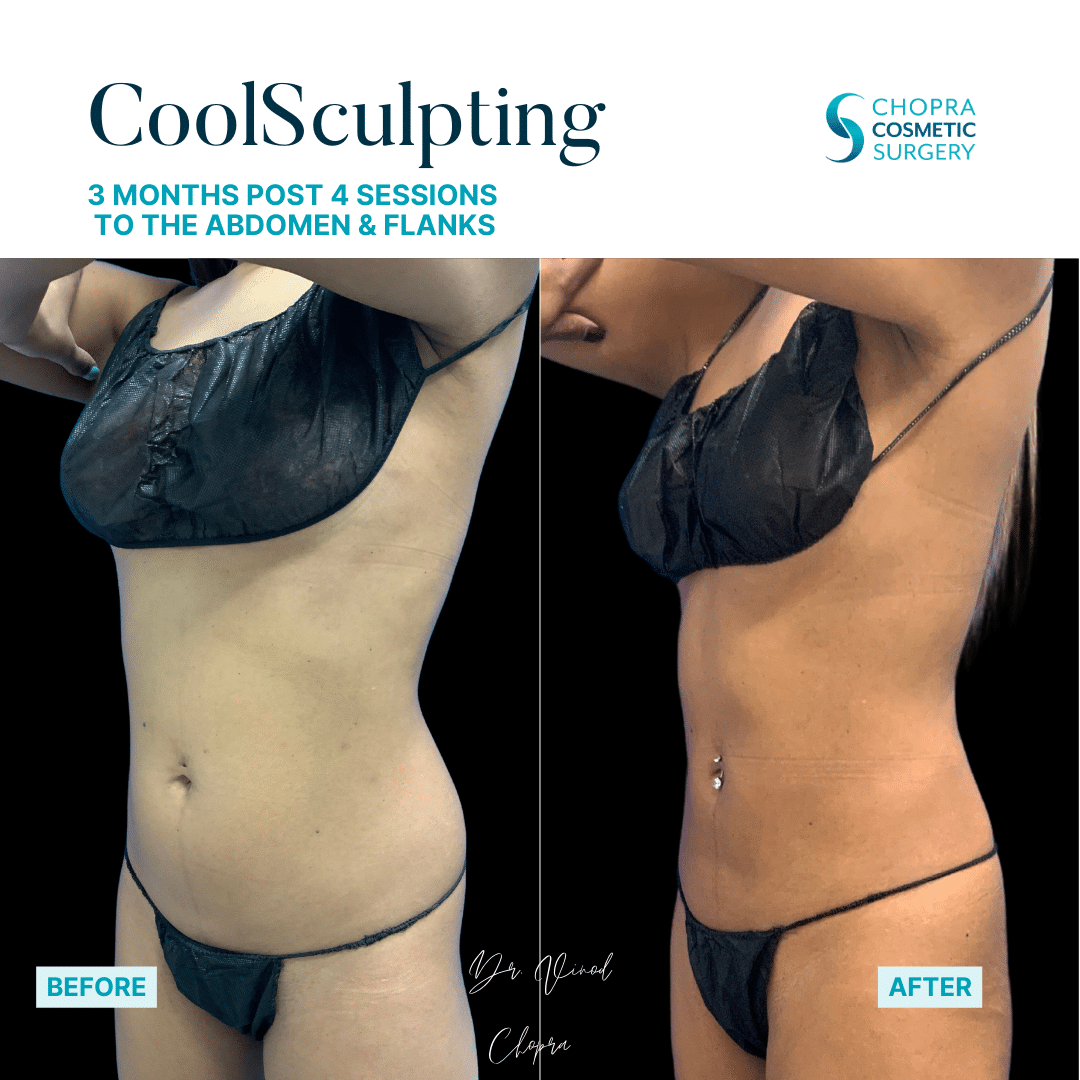 CoolSculpting Real Patient Results by Dr. Vinod Chopra in Washington, D.C. and Fairfax, VA