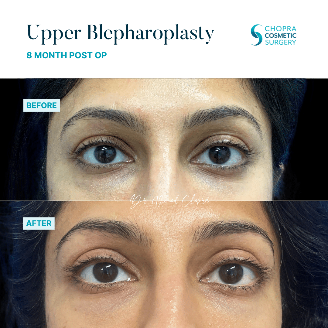 Blepharoplasty Real Patient Results by Dr. Vinod Chopra in Washington, D.C. and Fairfax, VA