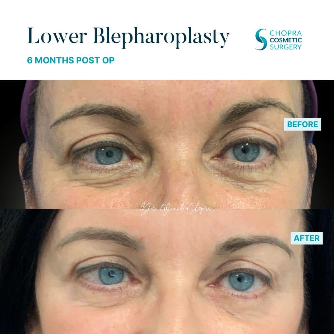 Blepharoplasty Real Patient Results by Dr. Vinod Chopra in Washington, D.C. and Fairfax, VA