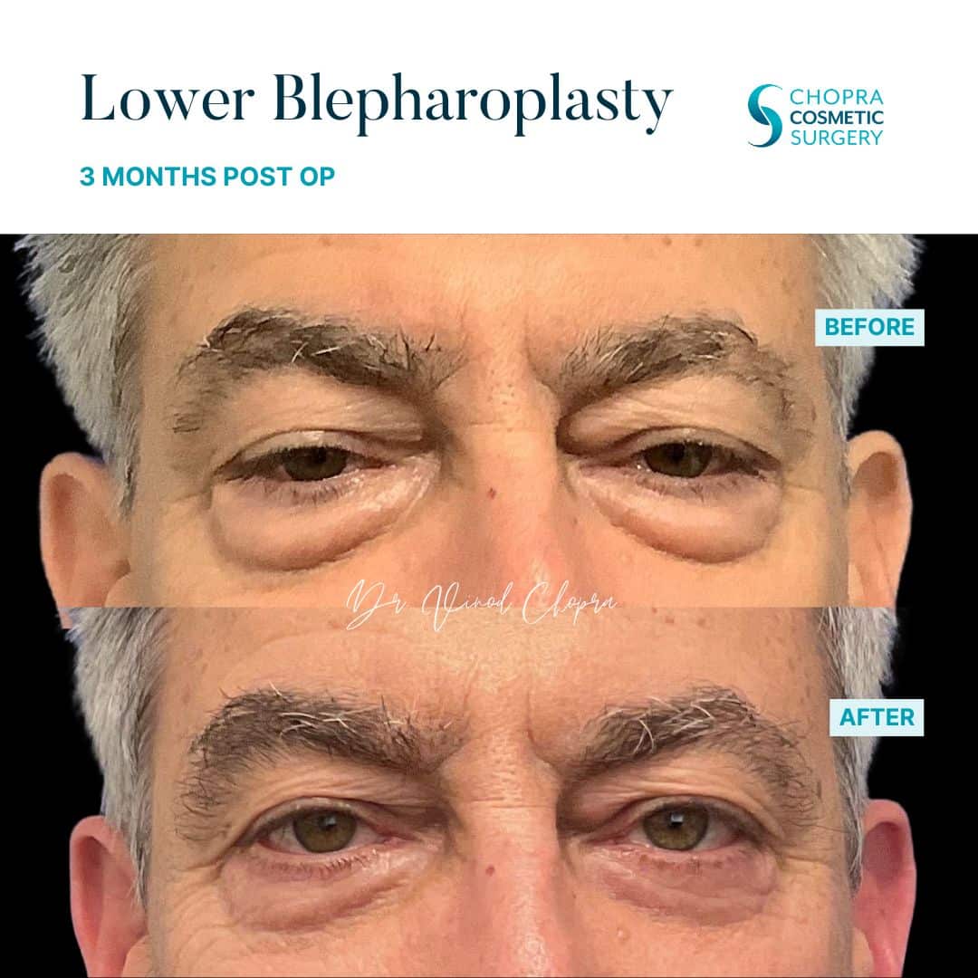 Blepharoplasty Real Patient Results by Dr. Vinod Chopra in Washington, D.C. and Fairfax, VA