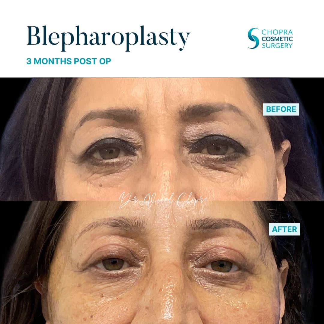 Blepharoplasty Real Patient Results by Dr. Vinod Chopra in Washington, D.C. and Fairfax, VA