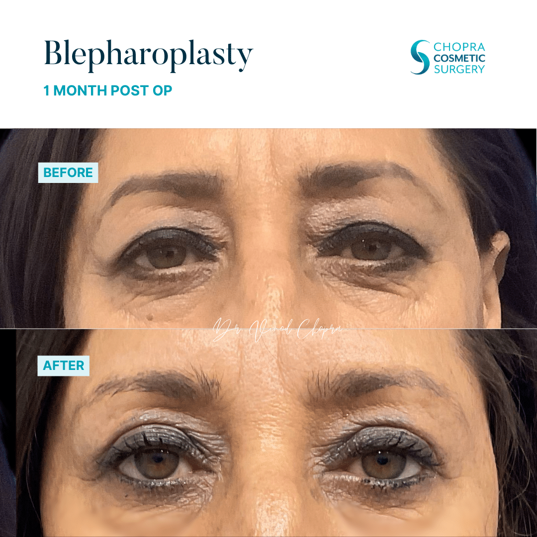 Blepharoplasty Real Patient Results by Dr. Vinod Chopra in Washington, D.C. and Fairfax, VA